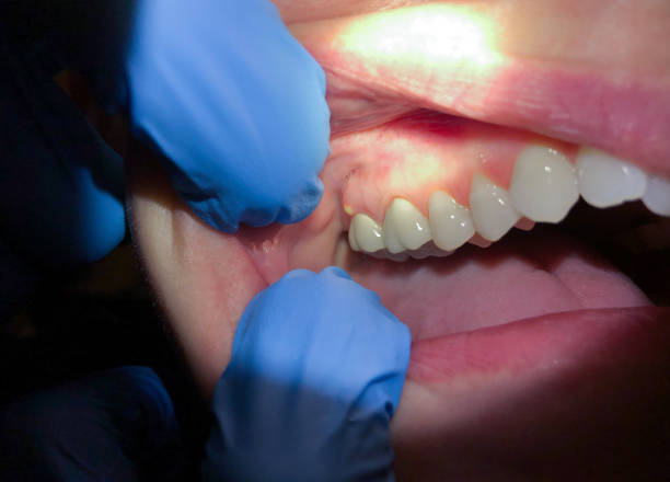 Best Emergency Gum Treatment in Eldorado At Santa Fe, NM